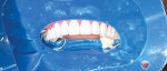 (23.) Posttreatment close-up view of the seated lithium disilicate veneers after final finishing and polishing.