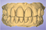 (6.) Pretreatment scan of the patient with the midline and incisal plane line transferred from the patient portrait. Note the horizontal lines added to indicate the desired incisal lengths and gingival heights. Teeth Nos. 9 and 10 will undergo greater gingival recontouring to correct the asymmetry among the zeniths and lower the smile line starting from tooth No. 8 so it is symmetrical bilaterally to the incisal plane
line.