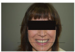 (5.) Interpupillary, midline, and incisal plane lines were added to the patient portrait to inform the smile design. Note the asymmetry of the heights of the gingival zeniths and how the patient’s teeth rise from the incisal plane line on 
her left side starting at the distal aspect of tooth No. 9.