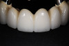 Figure 3  Preoperative view. Note the worn incisal edges and end-on-end occlusal relationship requiring an increase in OVD to restore.