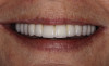 Figure 7  Length added to the incisal edge of mandibular anteriors and contoured to the proper occlusal plane.