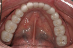 Figure 12  Postoperative mandibular occlusal view.