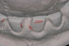 Figure 13  Initial matrix for mandibular rehabilitation. Anterior teeth may be provisionalized using the occlusal surfaces of the posterior teeth as stops.