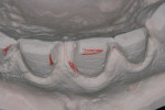 Figure 5  An alginate impression poured in Snap-Stone can be used to view preparations before final impression. Areas to adjust are marked in red.