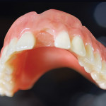 Figure 1  Example of tooth breakage and no acrylic adhesion—the lack of adhesion most likely caused the tooth to fail.