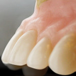 Figure 2  A fully contoured denture wax-up with adequate bulk at the gingival crest to provide strength to help retain the teeth in the denture.