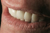 Figure 22. The postoperative result demonstrates the integrity of the bond and an optimal marginal adaptation to the tooth structure at the restorative interface using the adhesive design concept.