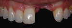 Figure 1  The patient's preoperative situation presented a difficult esthetic challenge for the dental team to recreate the missing teeth, gingival tissue, and bony arch.