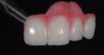 Figure 6  A pink composite was used to re-create the gingival.
