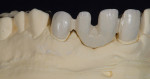 Figure 11  A metal framework allowed the author to maintain strength and proper embrasure spaces in the final prosthesis.