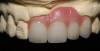 Figure 3  Diagram depicting lost palatal tooth structure restored with resin.