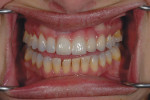 Figure 23  The final restoration was inserted and exhibited the proper gingival blends.