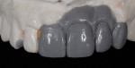 Figure 25  The ability to achieve the esthetic realities of the final case was made possible through the creation of a diagnostic wax-up to serve as a guide, and the fabrication of a provisional restoration that provided the technician direction for