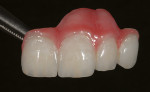 Figure 26  The ability to achieve the esthetic realities of the final case was made possible through the creation of a diagnostic wax-up to serve as a guide, and the fabrication of a provisional restoration that provided the technician direction for