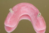 Figure 6  Characterization of the interproximal bone and tooth contacts: A periapical radiograph assists in measuring the distance from bone crest to the adjacent tooth contact points for missing tooth No. 8. The mesial bone crest to the adjacent tooth contact distance is < 5 mm, while the distal bone crest to adjacent tooth contact distance is > 6 mm (Fig 4). One-year following implant placement, conservation of these dimensions is revealed (Fig 5). The clinical photograph (Fig 6) of the lateral incisor adjacent to tooth No. 8 implant crown demonstrates that the absence of distal interproximal (papilla) fill related to the observed bone crest to contact distance exceeds 6 mm.