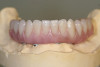 Figure 21   Gingival zenith planning: The location of the gingival zenith for this missing lateral incisor is not fully evident during initial clinical evaluation (Fig 21). Subsequent diagnostic waxing reveals the position of the planned gingival zenith (Fig 22). A thermoplastic template captures the position of the zenith and enables transferring this location to the clinical environment (Fig 23 and Fig 24). Final crown contours are defined by soft-tissue form (Fig 25).