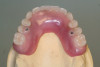 Figure 22  Gingival zenith planning: The location of the gingival zenith for this missing lateral incisor is not fully evident during initial clinical evaluation (Fig 21). Subsequent diagnostic waxing reveals the position of the planned gingival zenith (Fig 22). A thermoplastic template captures the position of the zenith and enables transferring this location to the clinical environment (Fig 23 and Fig 24). Final crown contours are defined by soft-tissue form (Fig 25).