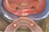 Figure 8  Photograph of the Class II veneer preparation demonstrating dentin exposure of 5% to 10%, less than the 20% maximum.