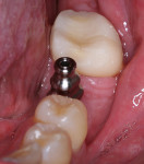 Figure 11  An impression coping is screwed into the implant for a closed-tray impression by the clinician.