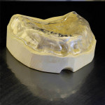 Figure 4  A clear baseplate trial maxillary denture was created for the patient.