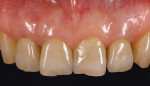Figure 7  Case 1 completion. The composite resin restoration on the remaining incisor was planned for later completion.