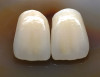 Figure 15  Full-thickness flap revealed severe bone loss, particularly in right canine–lateral incisor region.