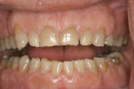 Figure 10  Close-up retracted preoperative with teeth separated. Note erosive lesions and asymmetric lower occlusal plane heights.