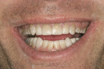 Figure 12  Initial mock-up revealed insufficient occlusal clearance for ideal length of the lower incisors.