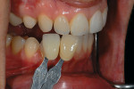 Figure 6  During the shade interview the author took basic shade photographs using standard manufacturer’s shade tabs to correctly match the veneers to surrounding natural dentition.