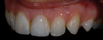 Figure 10  The author also took a series of photographs of the existing restorations and surrounding dentition on a black background to capture details of tooth characterization.