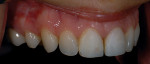 Figure 11  The author also took a series of photographs of the existing restorations and surrounding dentition on a black background to capture details of tooth characterization.