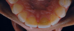 Figure 12  A mirror photograph of the lingual aspects of the maxillary teeth was taken to assess existing condition and color.