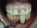 Figure 15  A photograph of the stump shade of tooth No. 9 was taken by the clinician and e-mailed to the author.