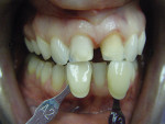 Figure 16  The author’s photographs of the preparations in the laboratory captured the high chroma of the preparation on tooth No. 9 and incisal flare on both teeth.