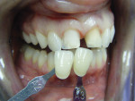 Figure 21  It is important to understand the differences from camera to camera. Comparing the author’s photographs of the prepared teeth to those of the clinician allows us to understand where and how miscommunication can happen.