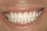 Figure 16  Final lateral smile.