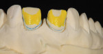 Figure 22  A tissue cast with removable dies was created for use in the refractory technique.