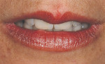 Figure 27  The final restorations with lips in repose.