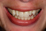 Figure 1  The patient expressed displeasure with the overly prominent appearance of her upper canines.