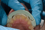 Figure 3  The matrix from the diagnostic wax-up shows the clinician the amount of tooth reduction needed.