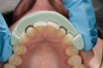 Figure 4  The facial view of the matrix helps to create an even and adequate reduction for the veneers.