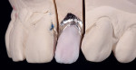 Figure 9   The canvas build-up of dentin, incisal translucency, and mamelons remains clear of the 1-mm line from the margin.