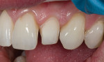 Figure 12  Final enamels were used for the supragingival preparation, blending the porcelain margin with the tooth structure.