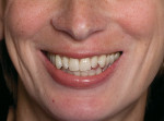 Figure 17  Frontal view of the patient before veneer placement shows the excessive reveal of the mesial aspect of teeth Nos. 6 and 11 and the wide incisal embrasures.