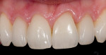 Figure 18  Frontal view after porcelain veneers were placed displays a better arrangement of the laterals.