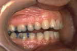 Figure 2  Intra-oral photograph of the right buccal dentition displaying an open bite and Class II Division I malocclusion. The only occlusal contacts are on the distal buccal cusps of the second molars. Note the flat curve of Spee.