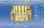 Figure 4  Frontal view of the IPS e.max CAD units on teeth Nos. 6 through 10.