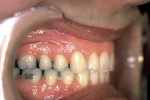 Figure 7  Postretention right buccal view displaying ideal Class I occlusion and stability.