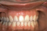 Figure 8  Postretention frontal view of the dentition, displaying ideal Class I occlusion and stability.