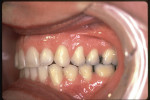 Figure 9  Postretention left buccal view displaying ideal Class I occlusion and stability.
